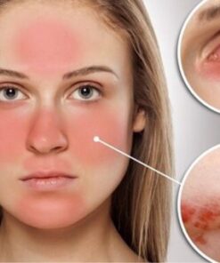 dinh-duong-cho-nguoi-mac-lupus-ban-do