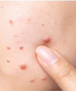 Hướng dẫn chăm sóc da mụn