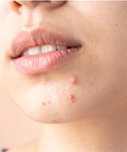 Khóa học chăm sóc da mụn tuổi dậy thì