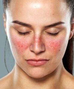 khoa-hoc-dinh-duong-cho-nguoi-mac-lupus-ban-do